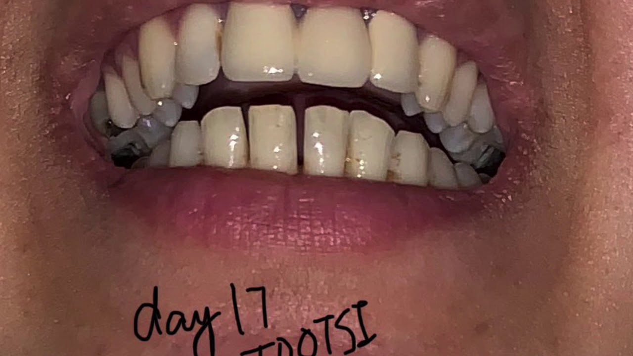 Toothsi clear aligner treatment for gaps , overjet n overbite ( review ...