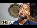 The Man Covered in Boils: Hidradenitis Suppurativa | Medical Documentary | Reel Truth