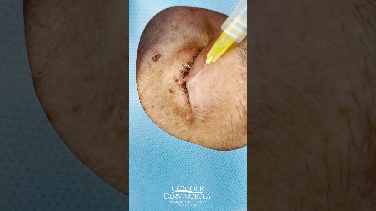 Removing Skin Tags On The Eyelid Shorts CONTOUR DERMATOLOGY