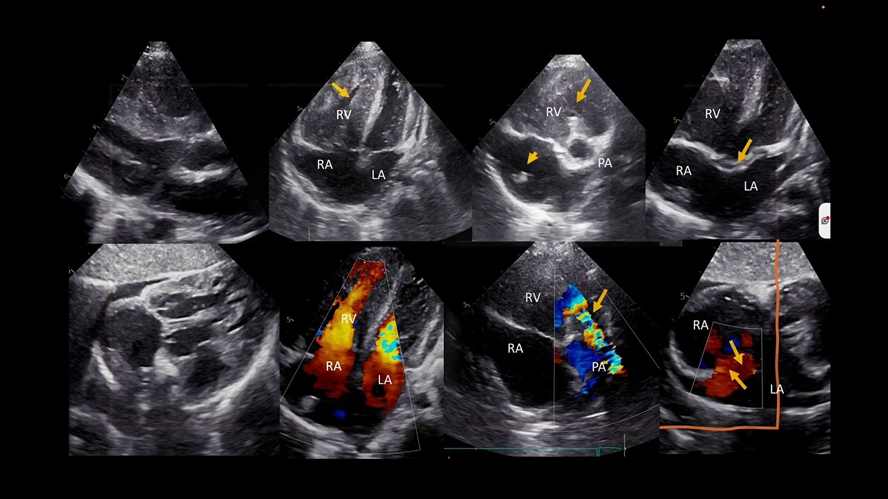 Эхокардиография при врожденном пороке сердца у взрослых с выявлением распространенных, нетипичных...