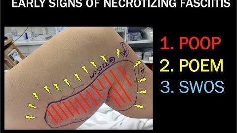 Necrotizing Fasciitis