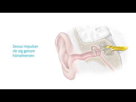 Video: Sensorineural Hörselnedsättning (neurit I Hörselnerven) - Vad är Det? Behandlingsmetoder