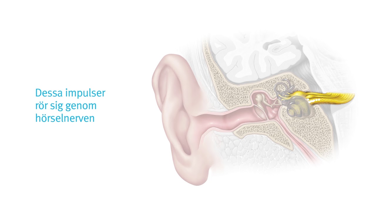 Vad orsakar nedsatt hörsel?