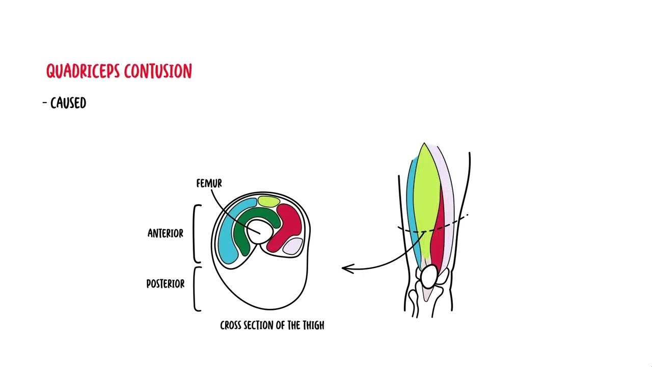 Quadriceps Muscle - quadriceps mujscle injury, strain, quadriceps contusion