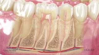 Qué es una endodoncia