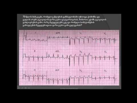 ეკგ / მარცხენა პარკუჭის გავრცელებული დაზიანება / მარცხენაპარკუჭოვანი უკმარისობა / marcxena parkuchi
