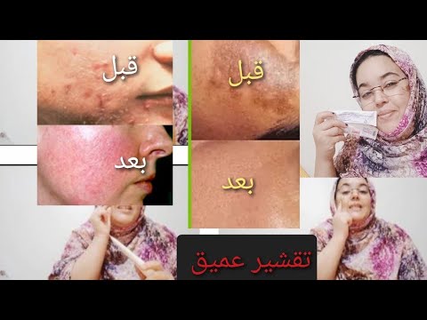 كريم يهنك من حبوب الوجه والكلف وجميع مشكل البشرة نعود تجربتي معه نجحة جدا