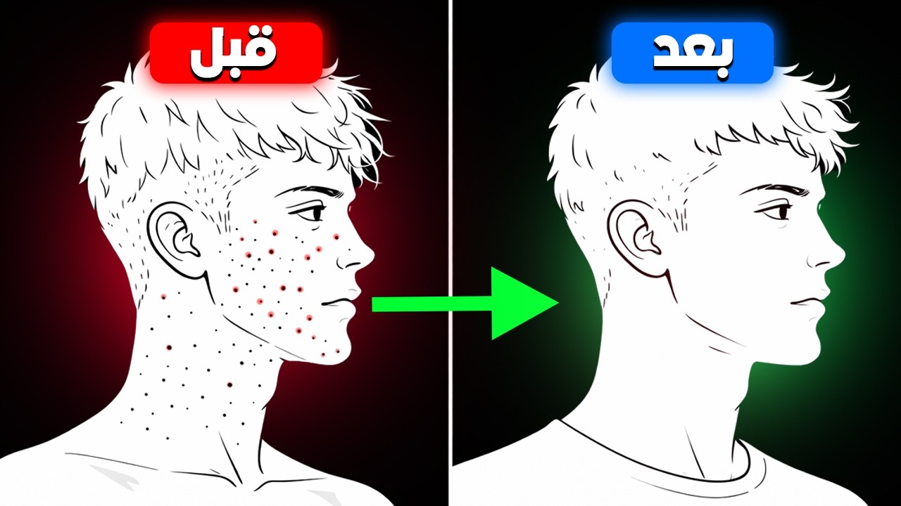 كيف تتخلص من حب الشباب في وجهك بشكل طبيعي في أسرع وقت | أحصل على بشرة نقية
