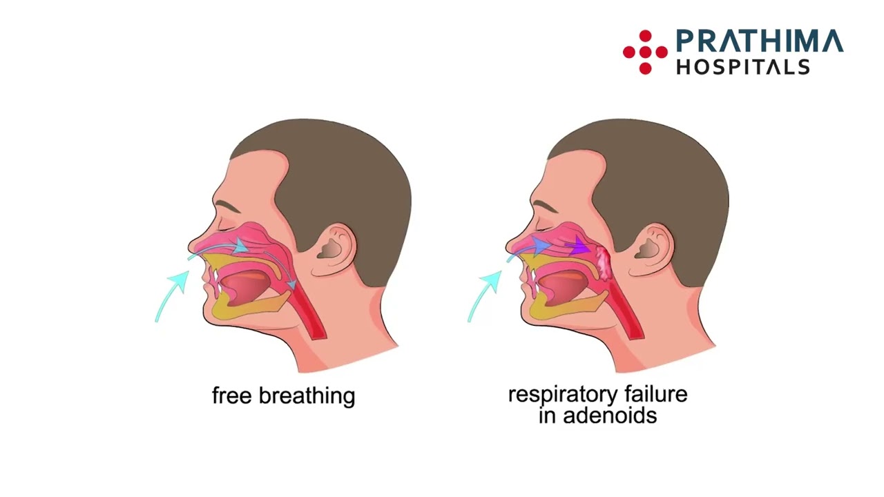 Dr. Santosh Kumar | Snoring Causes & Treatments | Prathima Hospitals Kukatpally