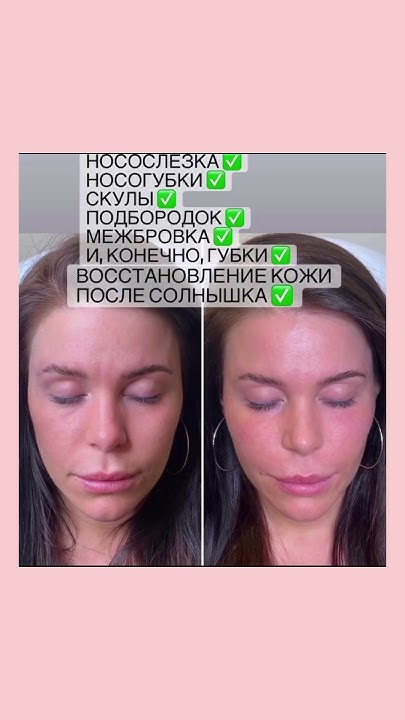 Акции этой недели: Губы 1мл 6900₽ и носогубки 1мл 6900₽ , Нити метелки ...