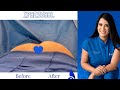 Xpress Liposuction | Preguntas frecuentes sobre BBL (Brazilian Butt lift) | pregúntale a la doctora