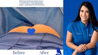 Xpress Liposuction | Preguntas frecuentes sobre BBL (Brazilian Butt lift) | pregúntale a la doctora