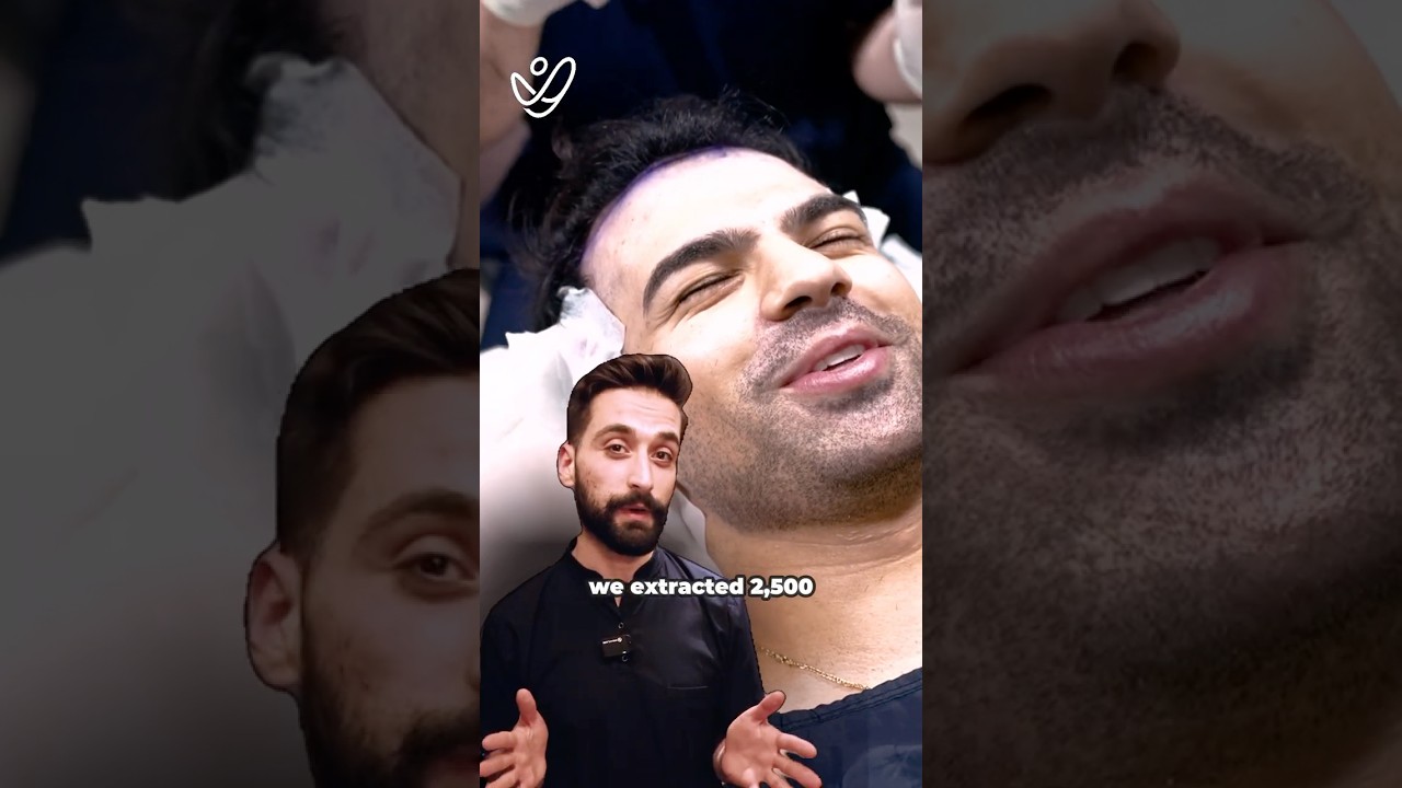 2500 Grafts DHI Hair Transplant | Type 3 Hair Loss Case Explained by Expert Doctor