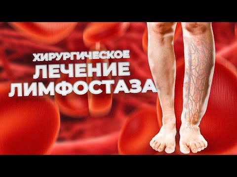 ЛИМФОСТАЗ - вылечить НАВСЕГДА возможно? Хирургическое лечение и диагностика лимфостаза.