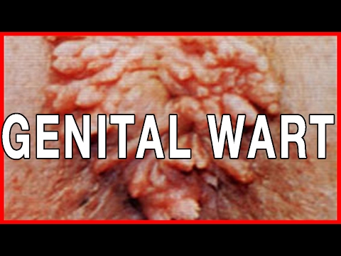 HPV And Genital Warts: Symptoms And Signs, Cure For Genital Warts
