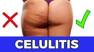 Elimina la Celulitis de Forma Natural: Estrategias Efectivas para una Piel Más Firme