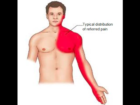 Иррадиация боли в левую руку
