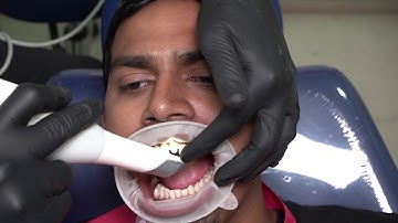 Replacing an anterior crown with the digital workflow