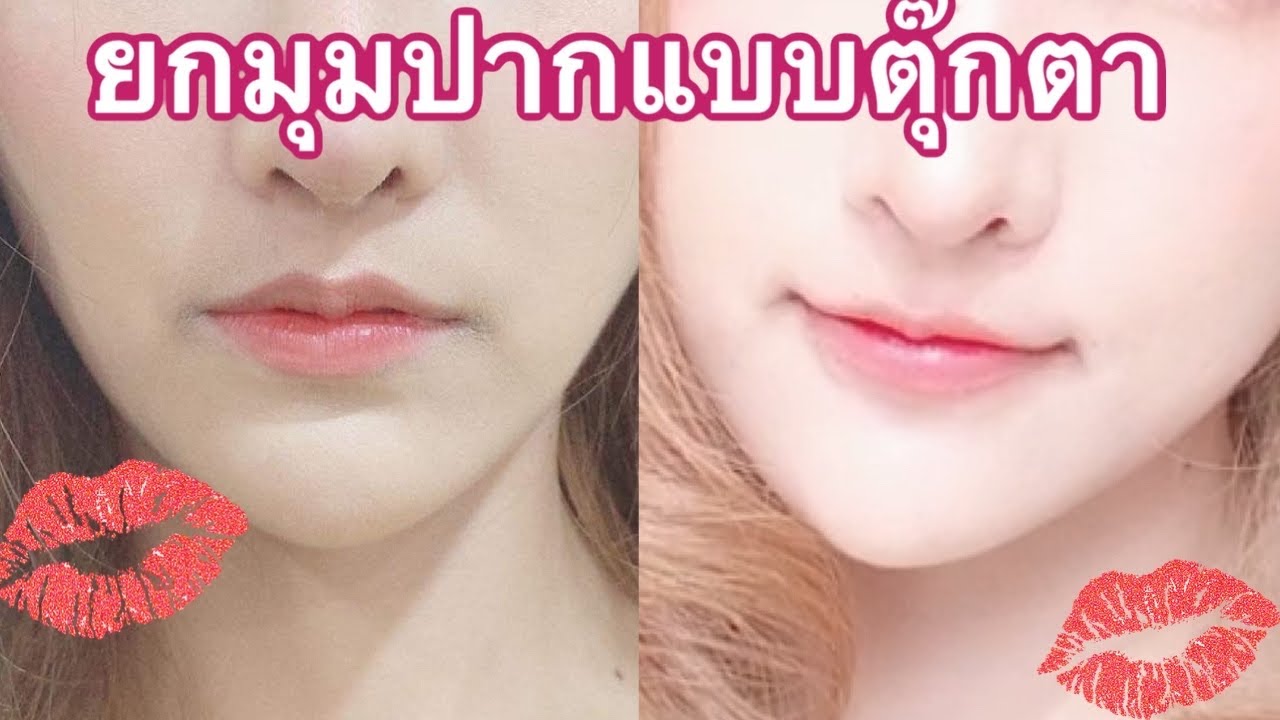 ศัลยกรรม ยกมุมปาก แบบตุ๊กตา ที่ รพ.Masterpiece ep.2/3