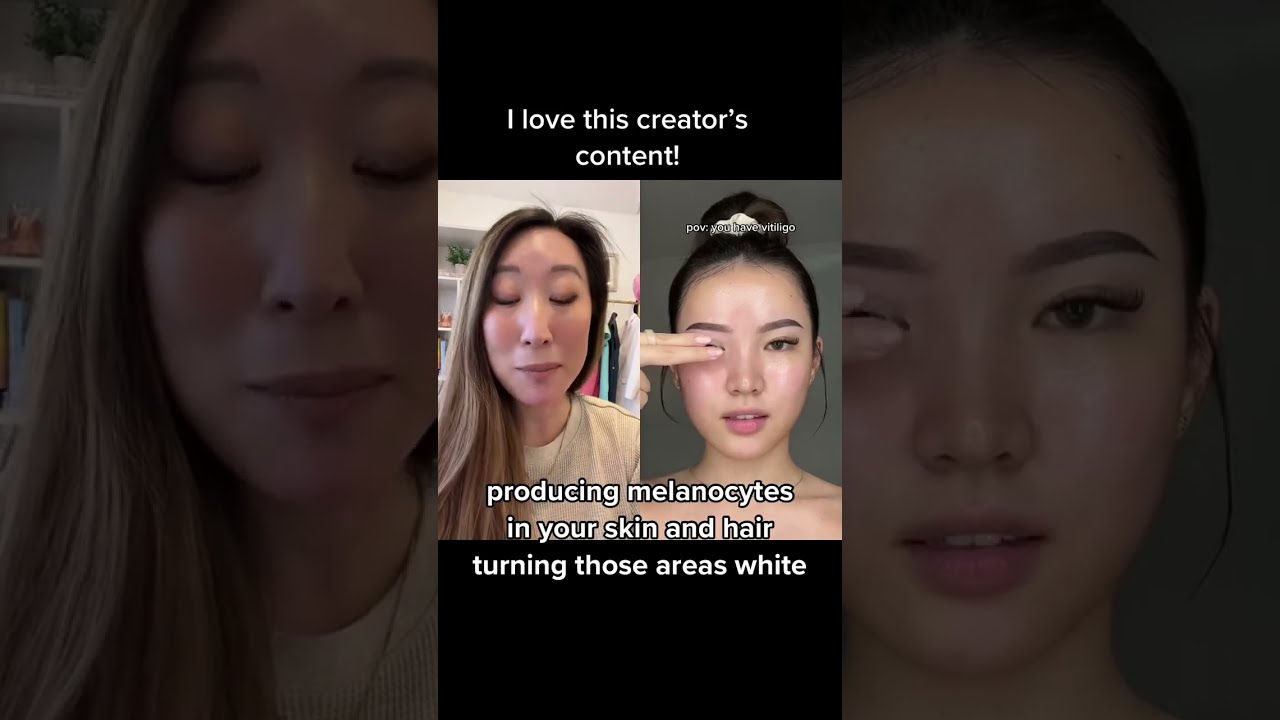  Vitiligo Is An Autoimmunedisease That Attacks Pigment In Your Skin Dermbypark