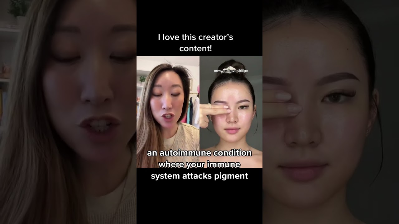 #vitiligo is an #autoimmunedisease that attacks pigment in your #skin #dermbypark