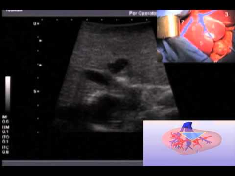 Echographie peroperatoire du foie - Dr Eric Vibert - YouTube