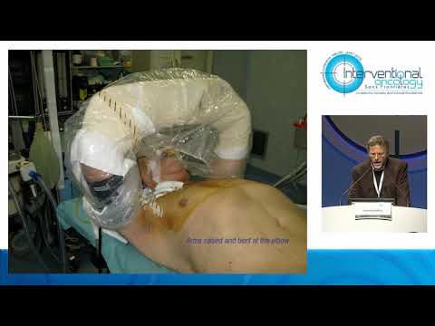 Cosmo Damiano Gadaleta - Double Track Therapy for Lung Cancer in Interventional Oncology