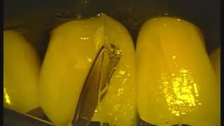 Bioclear Veneers - Fixing Black Triangle Gaps in Teeth