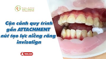 Cận cảnh quá trình gắn attachment invisalign răng hô -CG1797