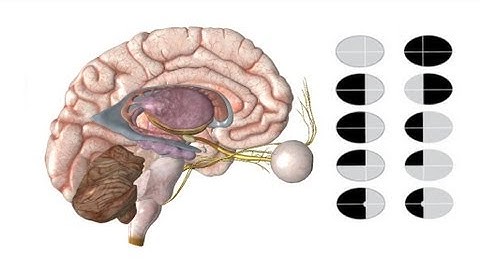 Visual Fields in 5 min
