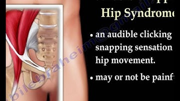 Snapping Hip Syndrome - Everything You Need To Know - Dr. Nabil Ebraheim