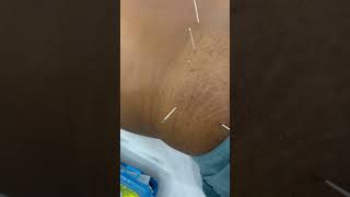 Back and buttocks pain relief treatment #drgovindyadav#viral #shortvideo #trending #viralvideo#pain