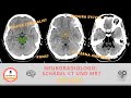 Anatomie im CT und MRT Schädel