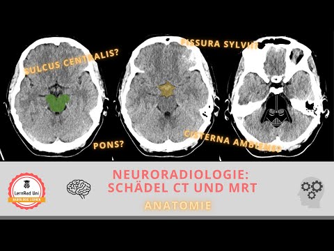 Video: Einfluss Klinischer Entscheidungsregeln, Patientenkosten Und Informationen Zu Behandlungsfehlern Auf Die Reihenfolge Der CT-Bilder Im Gehirn Des Klinikers: Eine Randomisierte Kontr