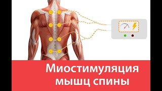 МИОСТИМУЛЯЦИЯ. Что это такое? Для чего? Как?