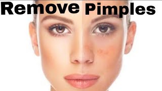 7 दिन में कील मुंहासे (Pimples Acne) जड़ से खत्म करें |