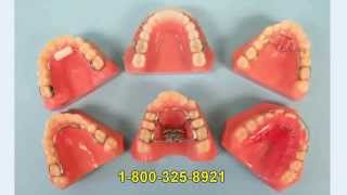 Habit Appliances | Dental Habit Appliances | Habit Appliance Labs