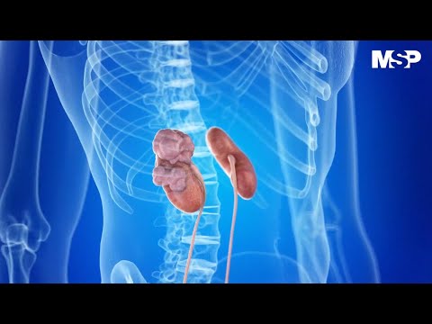 Video: Cómo prevenir el cáncer de riñón: 12 pasos (con imágenes)