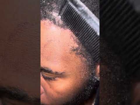 Crouching Scalp Hidden #Flakes
