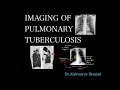 Imaging of pulmonary tuberculosis a detailed radiologic review  checklist for reporting 