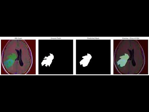 Segmenting Brain Tumor MRI Images | UNet | Deep Learning | Semantic Segmentation | Keras | Python 