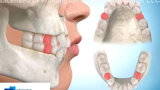 Four-bicuspid Extraction all 2nd