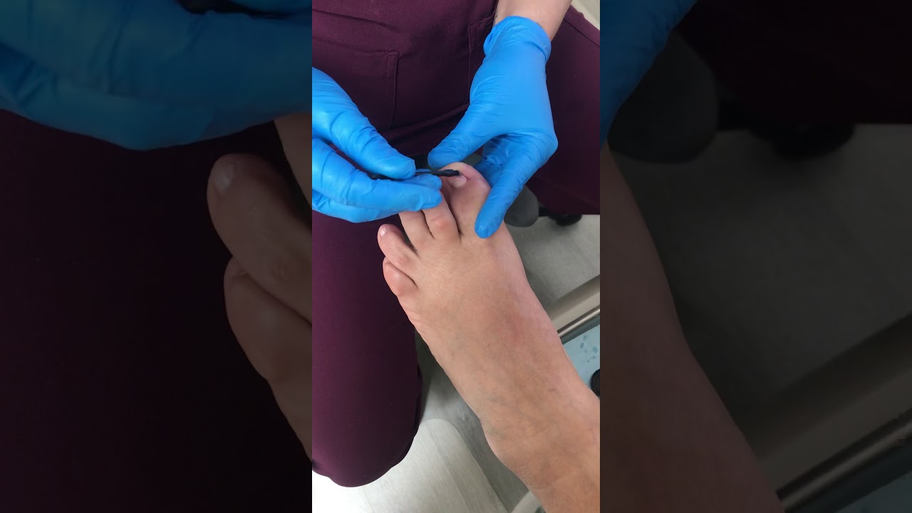 Keryflex nail restoration system YouTube