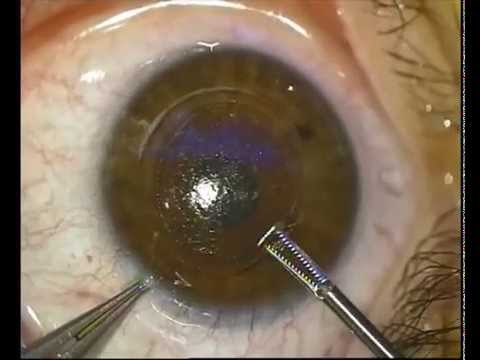 operație miopie rău patologia vederii periferice
