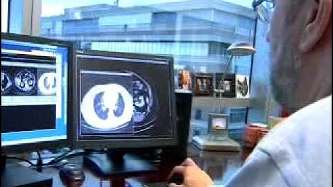 2011-10/12 HEALTHY MEN TAKING VITAMIN E SUPPLEMENTS INCREASE RISK OF DEVELOPING PROSTATE CANCER