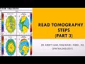 How to read corneal tomography printout  pentacam