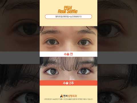원더트임 뒤트임+눈꼬리내리기수술 당일 / 1주 / 2주 후기