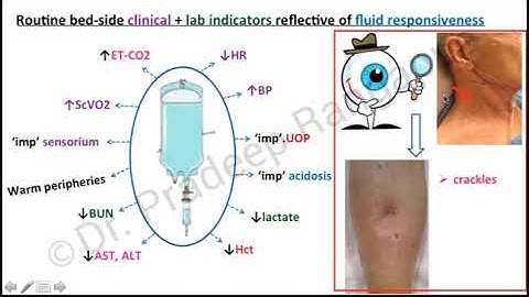 Fluid responsiveness in Resource limited setting | Dr Pradeep Rangappa
