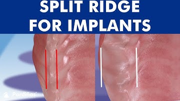ALVEOLAR RIDGE EXPANSION - Dental implant placement with bone ridge splitting ©