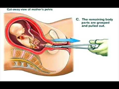 Abortion Illustrated / 23 Weeks Gestational Age / Video